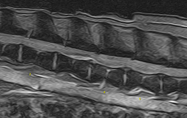 Intervertebral disc disease